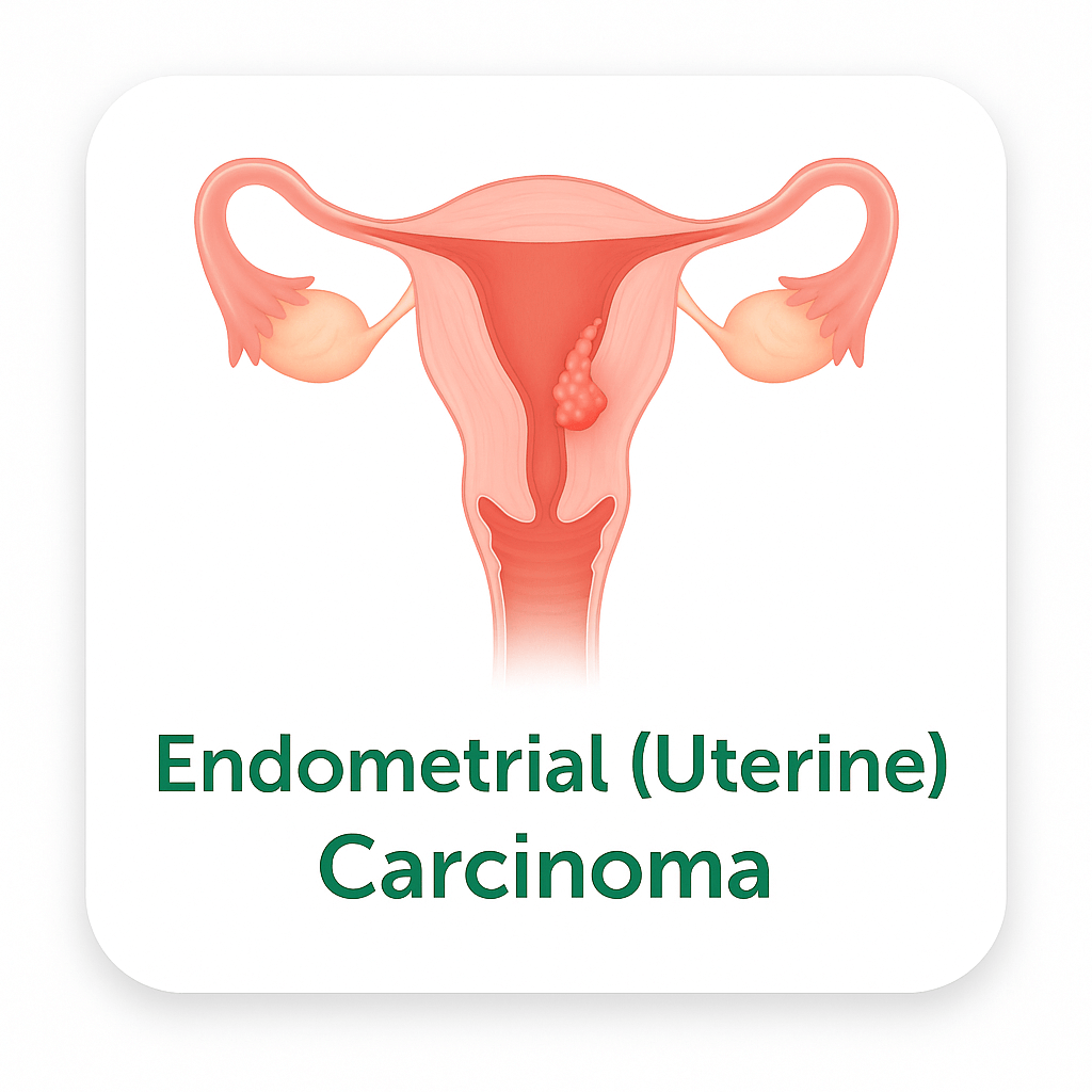 Endometrial (Uterine) Carcinoma – Extension