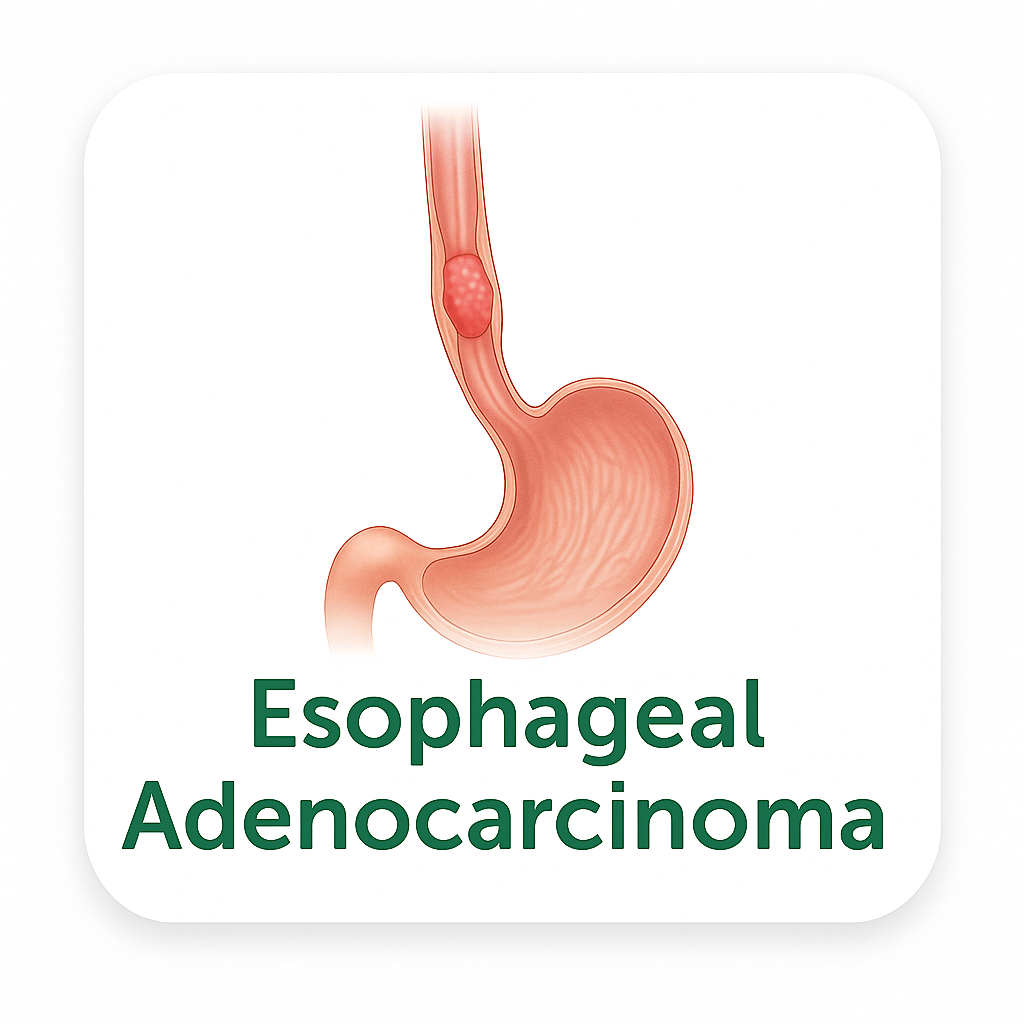 Esophageal Adenocarcinoma