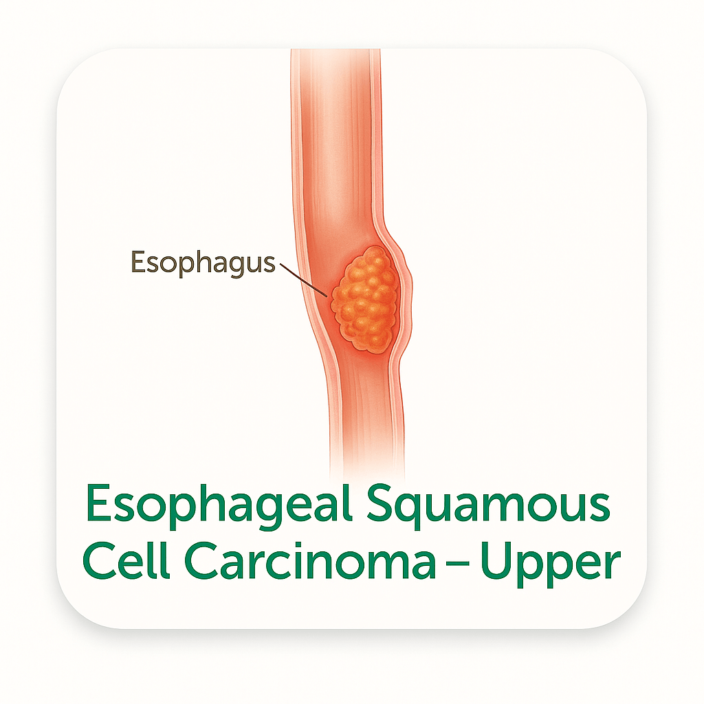 Esophageal Squamous Cell Carcinoma – Upper