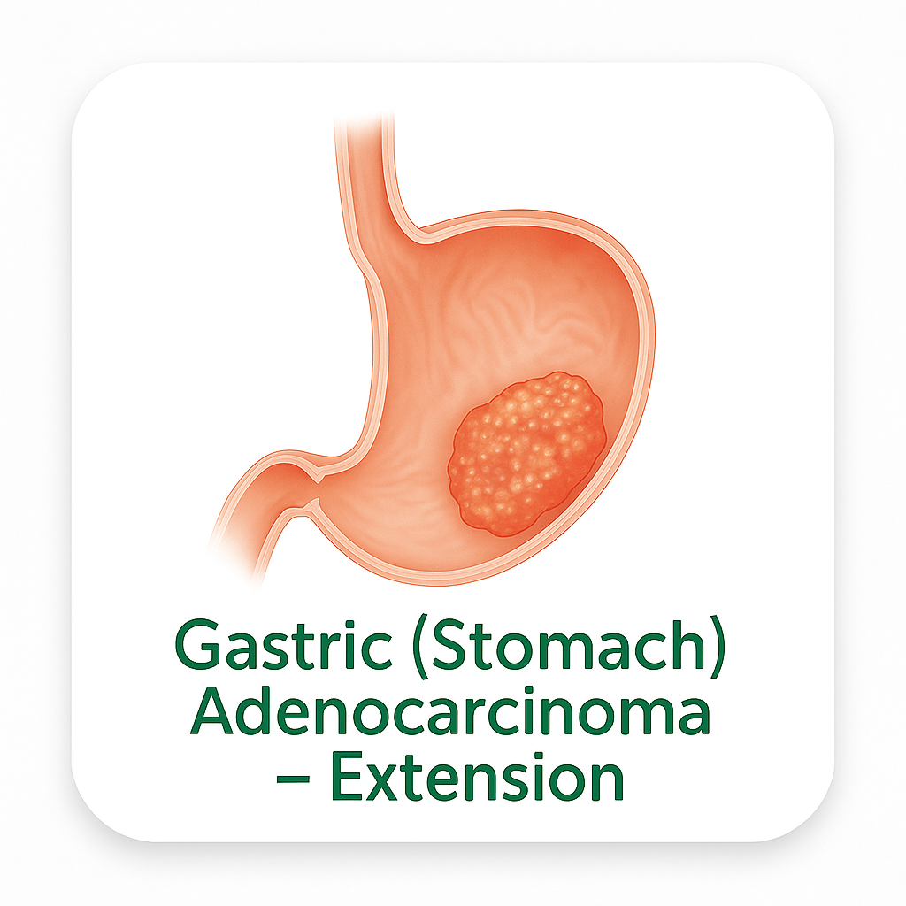 Gastric (Stomach) Adenocarcinoma – Extension